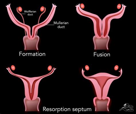 Mullerian Agenesis Ultrasound