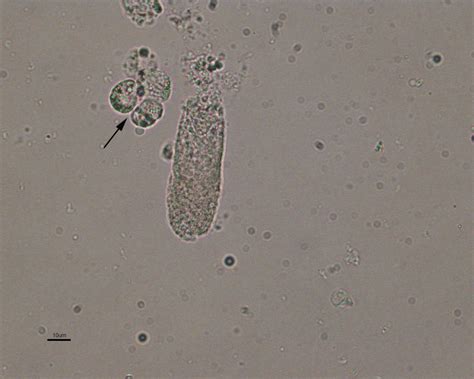 Urine casts | eClinpath