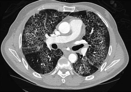 Crazy paving - Libre Pathology