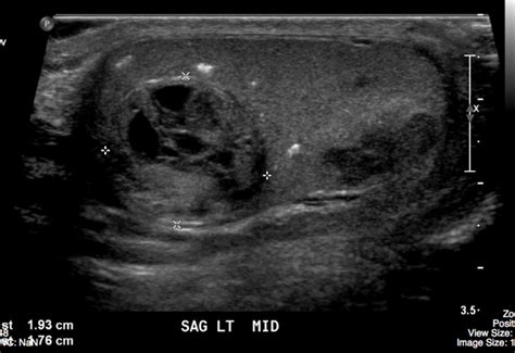 Testicular Tumour – Undergraduate Diagnostic Imaging Fundamentals