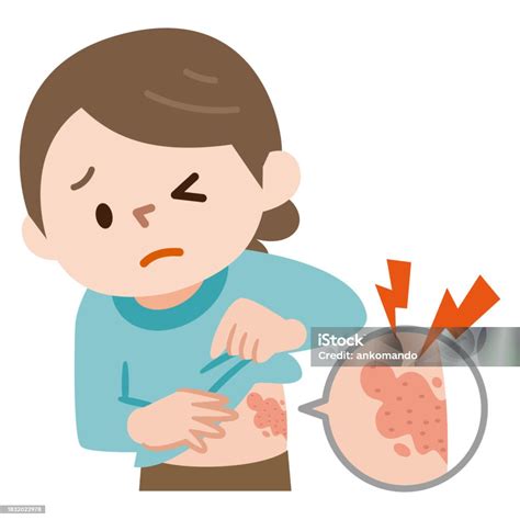 Vector Illustration Of The Symptoms Of Shingles Stock Illustration ...