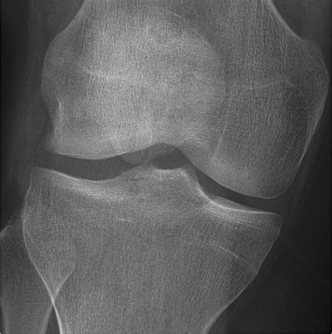 Schatzker Fracture Classification