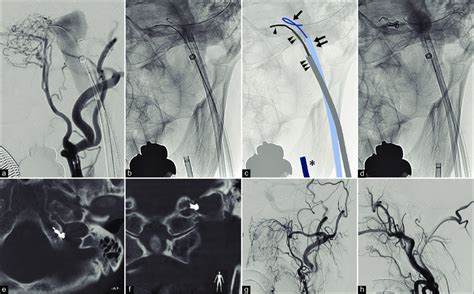 Endovascular treatment of dural arteriovenous fistula (a-d) and... | Download Scientific Diagram