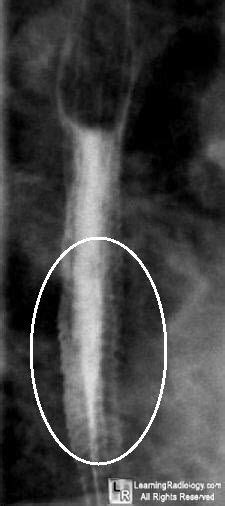 Feline esophagus - prominent transverse folds in esophagitis | Radiology, Esophagitis, Signs