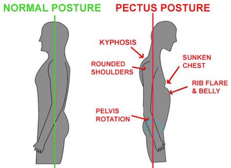 Top 7 Causes of Pectus Excavatum – Is it Genetic? & More