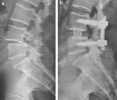 Minimally invasive surgery procedure in isthmic spondylolisthesis | Semantic Scholar