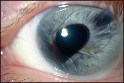 Anterior Chamber IOL Complications and Management | Ento Key