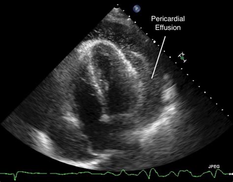 Atypical presentation of STEMI with pericardial effusion causing cardiac tamponade related to ...