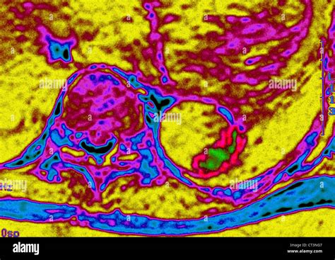 AORTIC DISSECTION, MRI Stock Photo - Alamy