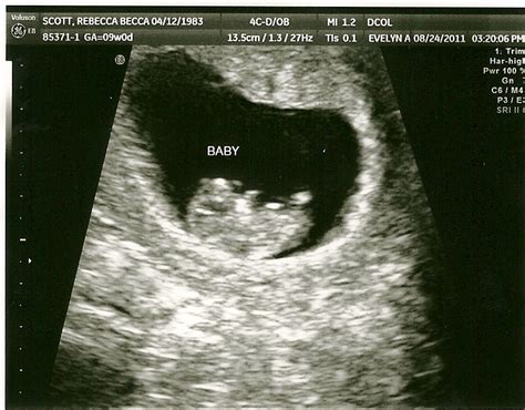 The Scotts: Baby Makes Three: First Ultrasound...9 weeks