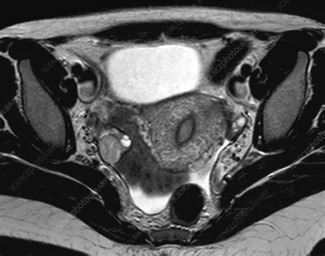 Normal female pelvis, MRI - Stock Image - C026/9011 - Science Photo Library