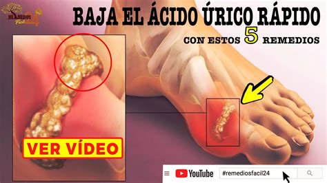 Como BAJAR el ACIDO URICO Rapidamente CON 5 Remedios para el Acido Urico - YouTube