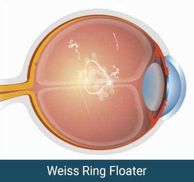 What Are Eye Floaters? | David Richardson, MD - Glaucoma, Cataract Surgeon California