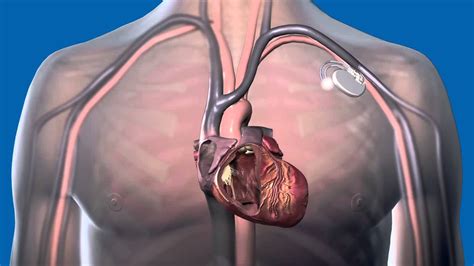 Best Heart Surgery Hospital in India: Pacemaker implantation Surgery in ...