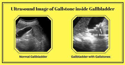 Gallbladder Removal Surgery in Chennai | Gallstones Treatment