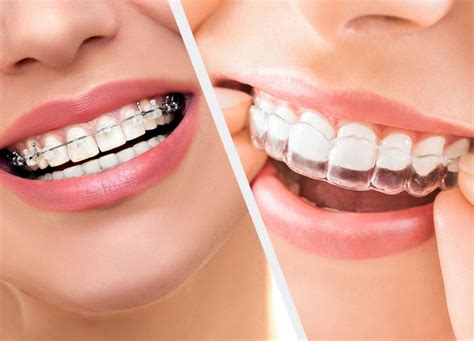 Why Orthodontic Treatment Is Important | Orthodontist Whitby | Braces Whitby | Invisalign Whitby