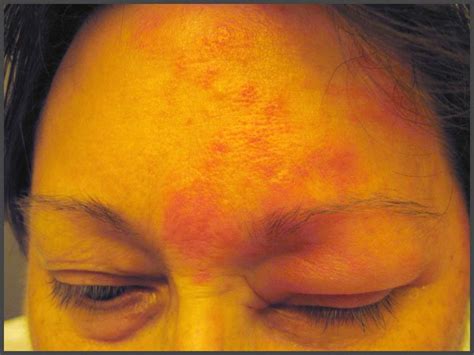 Shingles pictures face | Shingles Expert