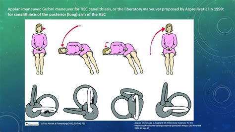 Appiani+maneuver,+Gufoni+maneuver+for+HSC+canalithiasis,+or+the+liberatory+maneuver+proposed+by ...