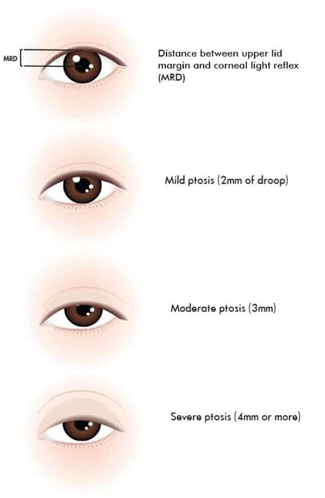 Mild Congenital Ptosis