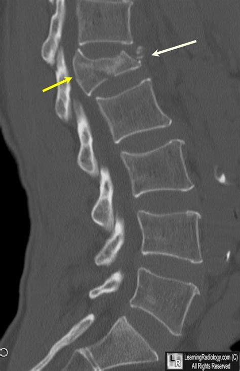 Burst Fracture of Lumbar Spine. Sagittal reconstruction of CT of the ...