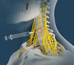 Stellate Ganglion Block Newport Beach, CA | Nerve Injury Newport Beach, CA