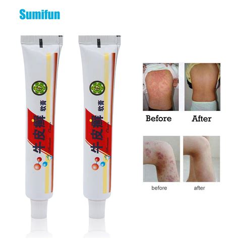 1pcs Psoriasis Creams Body Pain Relief Herbal Eczema Psoriasis Ointment ...