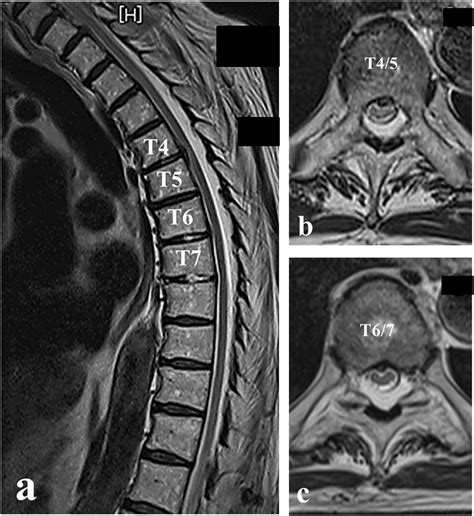 Mri Thoracic Spine Bulging Disc | sexiezpix Web Porn