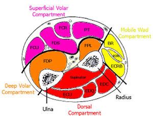 Compartment syndrome - WikEM