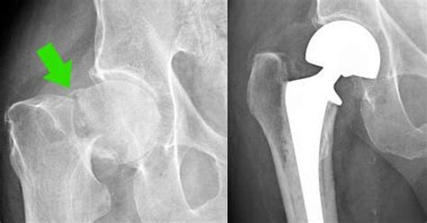 Femoral Neck Fracture Hemiarthroplasty