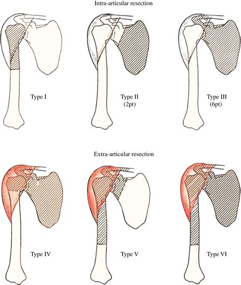 Functional Results and Emotional Acceptance after Scapulectomy for ...