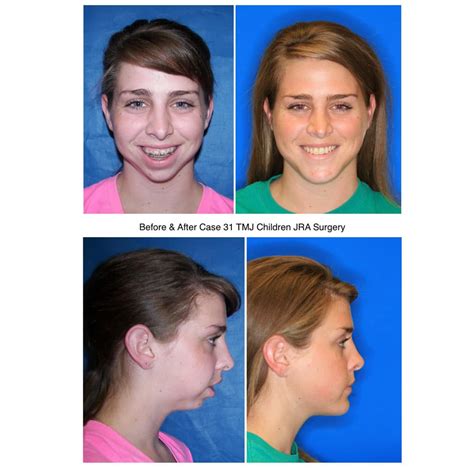 Before and After Photos Maxillofacial Surgery - Larry M. Wolford, DMD