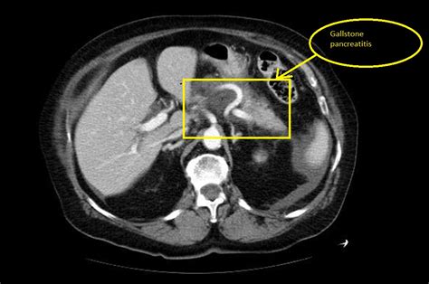 Acute pancreatitis CT - wikidoc