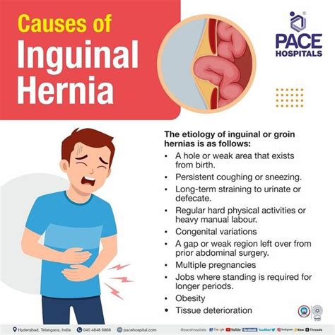 Inguinal Hernia Signs And Symptoms, Types, Causes, Risk, 51% OFF