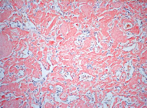 BioGenex Special Stain - Amyloid (Congo Red) in Liver 20x Amyloid is an abnormal, fibril-like ...