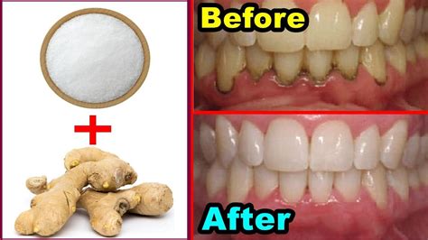 How To Make Your Teeth White With Salt - TeethWalls