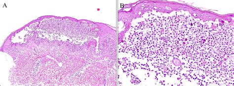 [PDF] Pyodermatitis-Pyostomatitis Vegetans Associated with Crohn's Disease | Semantic Scholar