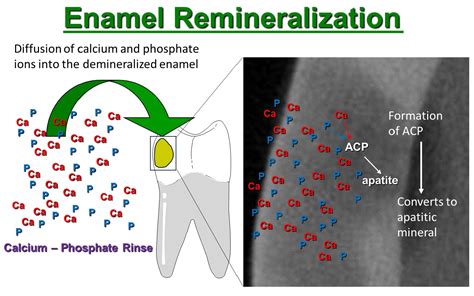 Dentistry Journal | Free Full-Text | Remineralization of Early Enamel ...