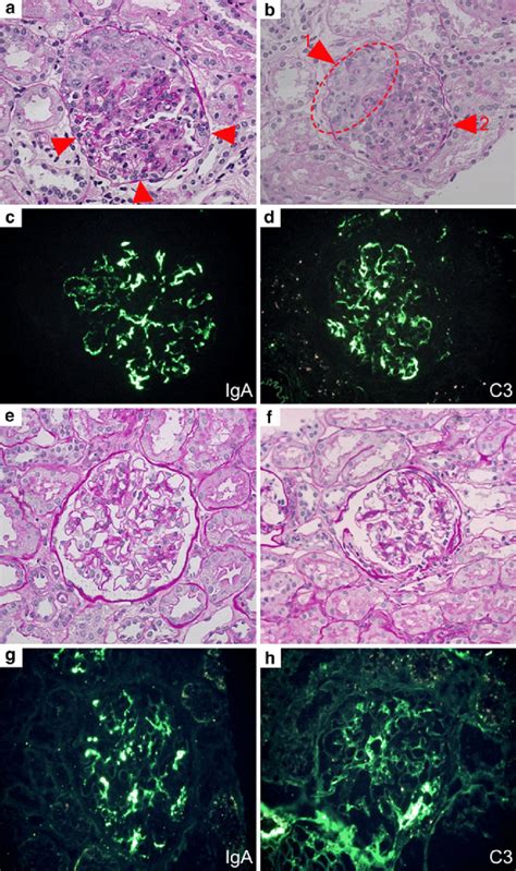 Renal biopsy findings. Panels a-d Initial renal biopsy findings a Light... | Download Scientific ...