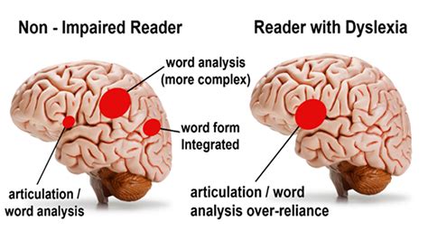 Understanding Dyslexia – Cognitive Development Learning Centre