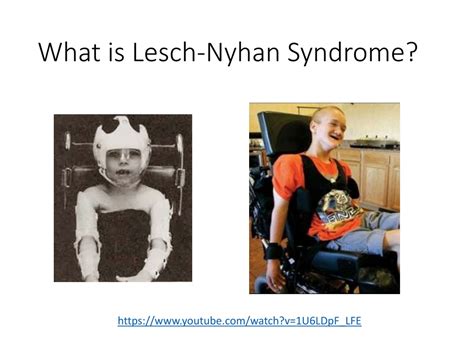 PPT - Lesch-Nyhan Syndrome (LNS) and the HPRT1 Gene PowerPoint ...