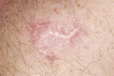 Skin cancer scar - Stock Image - C002/4950 - Science Photo Library