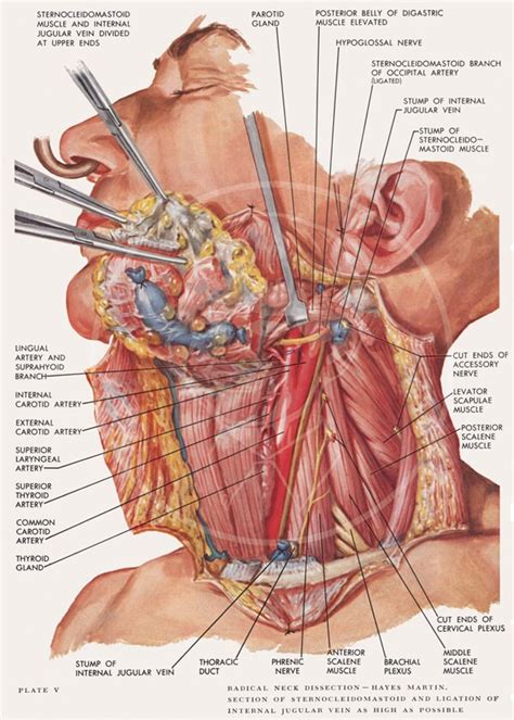 Plate 5: Radical Neck Dissection 10x14 Giclée Canvas Print