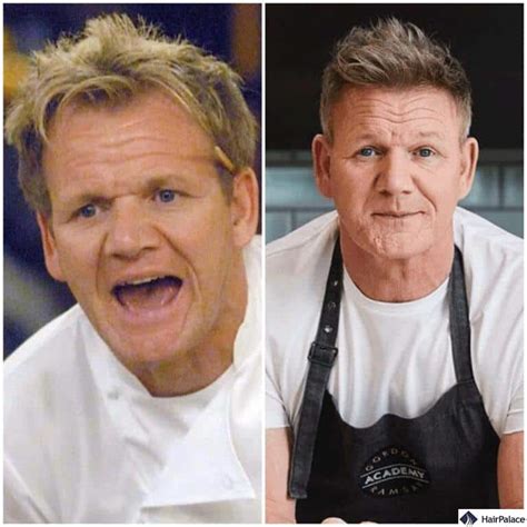 Gordon Ramsay Hair Transplant | How much did it cost?