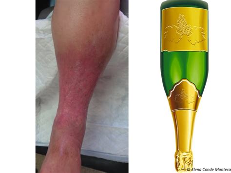 6 reasons why a venous ulcer does not heal despite compression therapy - Elena Conde