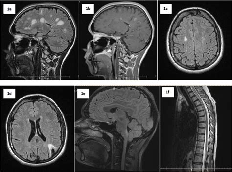 Differential diagnosis of multiple sclerosis and other inflammatory CNS ...