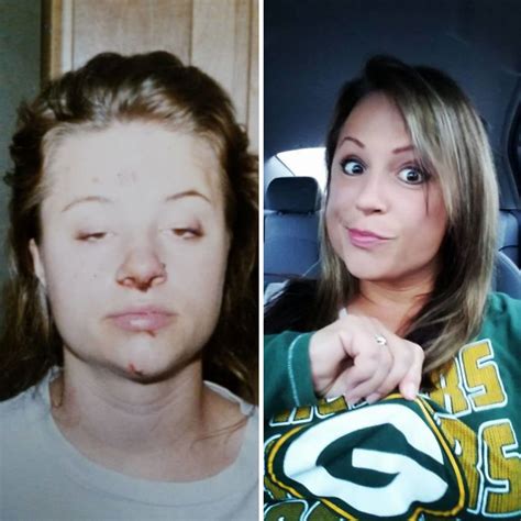 96 Stunning Before & After Photos Of People Who Quit Hard Drugs Like Heroin