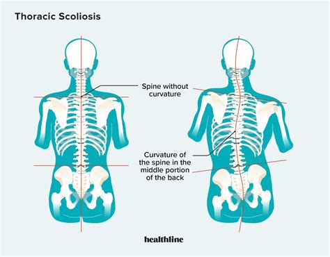 Thoracic Scoliosis: Symptoms, Causes, Treatments, and More