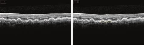 The left figure shows SD-OCT image of an eye with drusen. The drusen... | Download Scientific ...