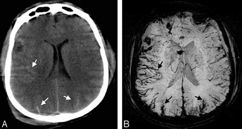 A, CT scan shows high-attenuation signals within the sulci of the ...