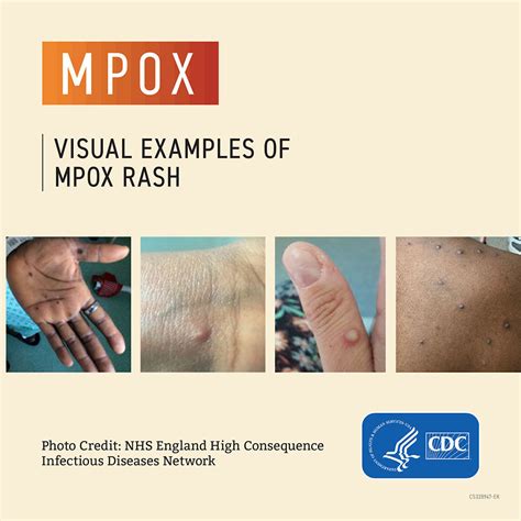 Mpox | Department of Health | Commonwealth of Pennsylvania